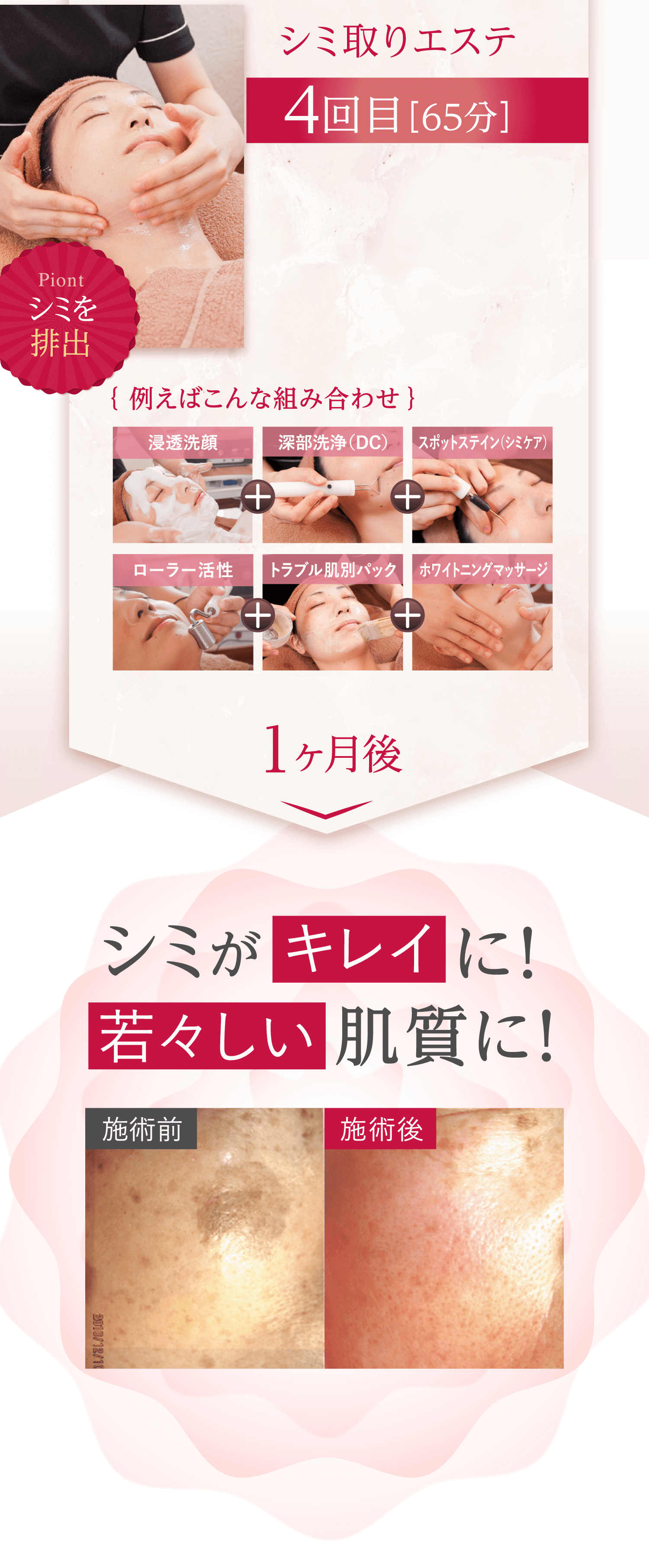 シミ取りエステ 4回目［65分］ Piont シミを排出 ｛ 例えばこんな組み合わせ ｝ 浸透洗顔 深部洗浄（DC） スポットステイン（シミケア） ローラー活性 トラブル肌別パック ホワイトニングマッサージ1ヶ月後
